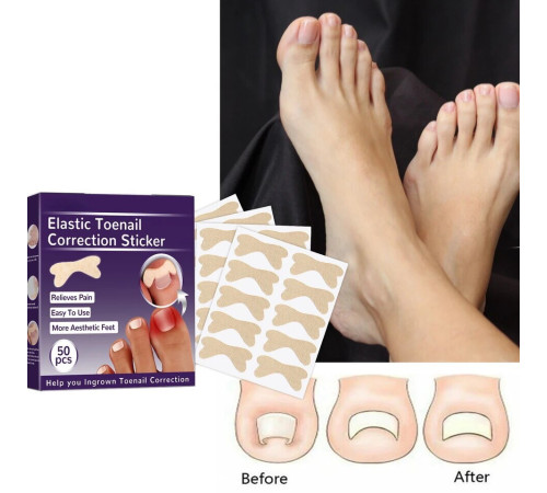 Пластырь  Для  НОГТЕЙ   , корректирующие наклейки для ногтей 9388--2 (1000)